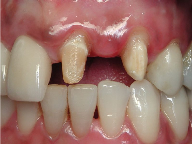 Tooth gap