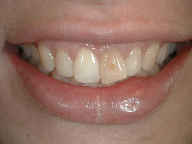 Discolored Front Tooth