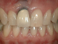 Discolored Crowns