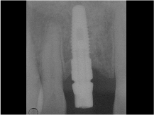 X-Ray of implant