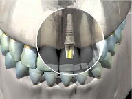 Tooth Implant 3D
