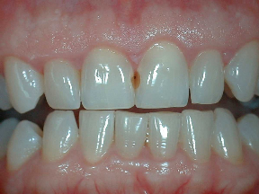 Discolored fillings