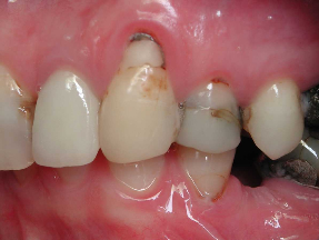 Decayed Teeth