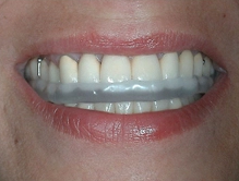 This picture shows a hard acrylic nightguard covering the biting surfaces of the upper teeth.